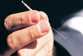 La acupuntura es uno de los tratamientos más utilizados para tratar en hipo crónico.