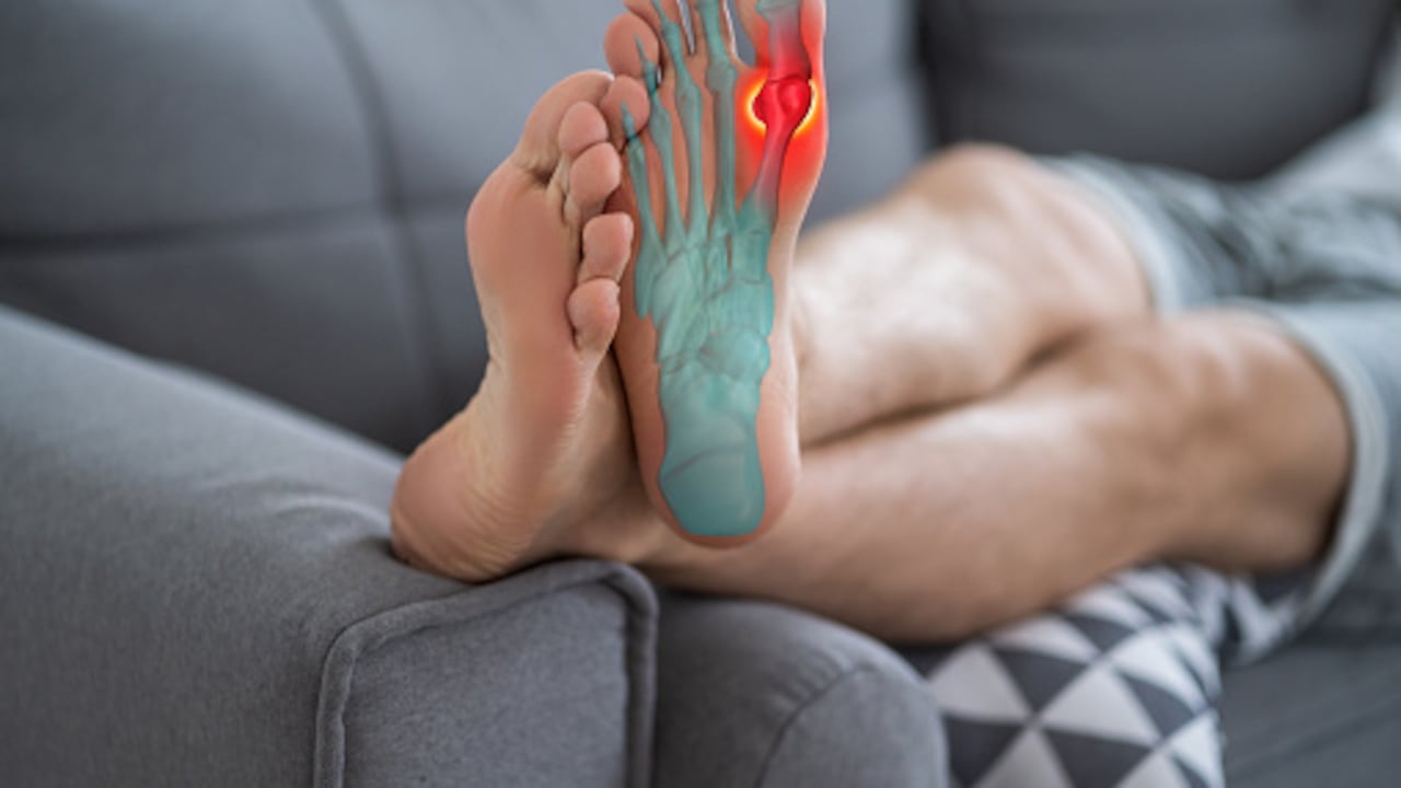 El ácido úrico puede ocasionar piedras en los riñones.