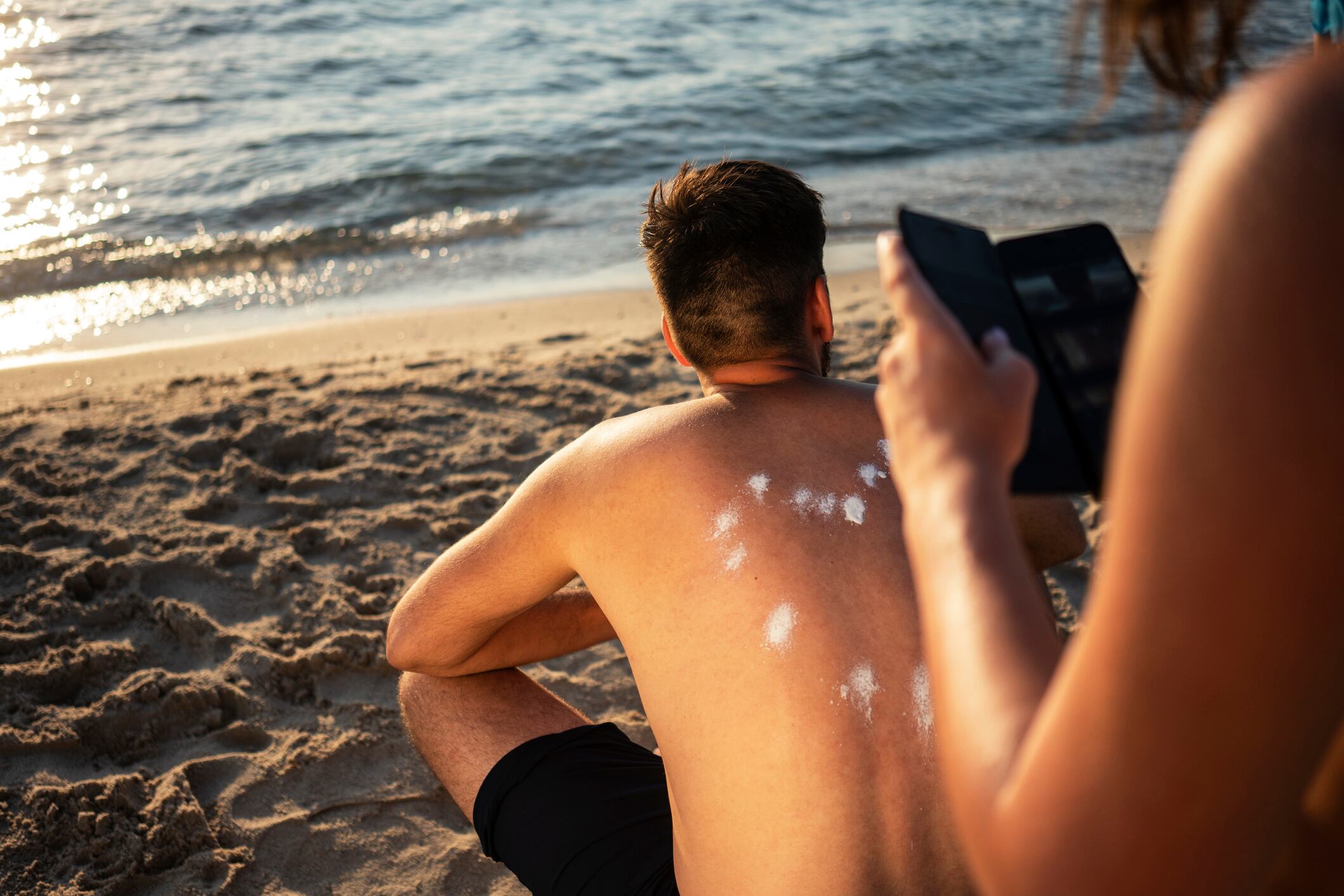 Foto de referencia sobre piel quemada