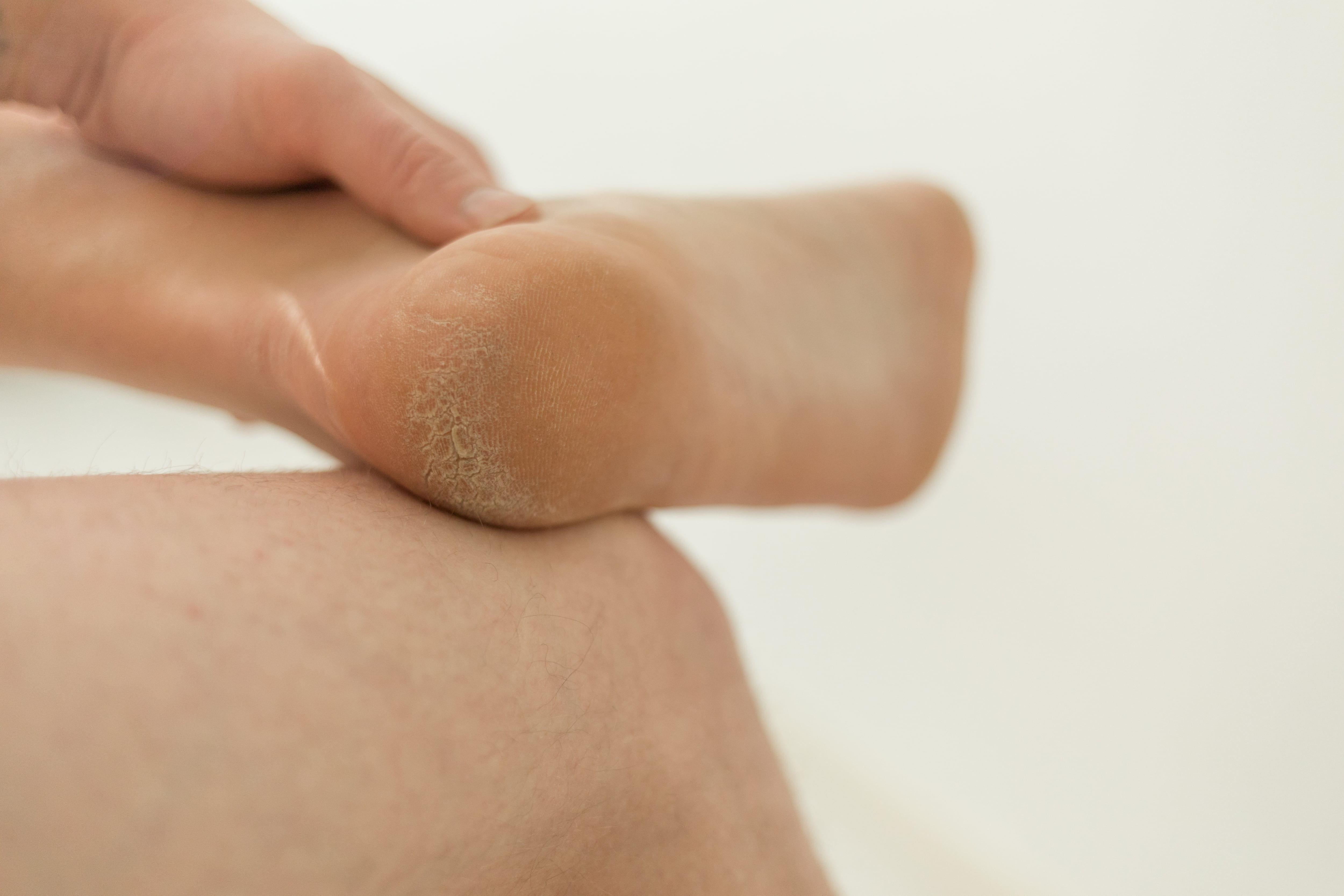 El uso de zapatos apretados causa callosidades.