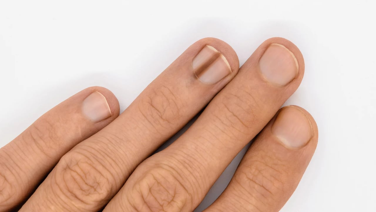 ¿Por qué salen líneas negras en las uñas?