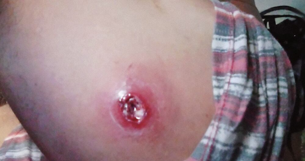 Los privados de la libertad enfrentan graves infecciones por el consumo de agua. Así se ve la piel de uno de los internos infectado. 