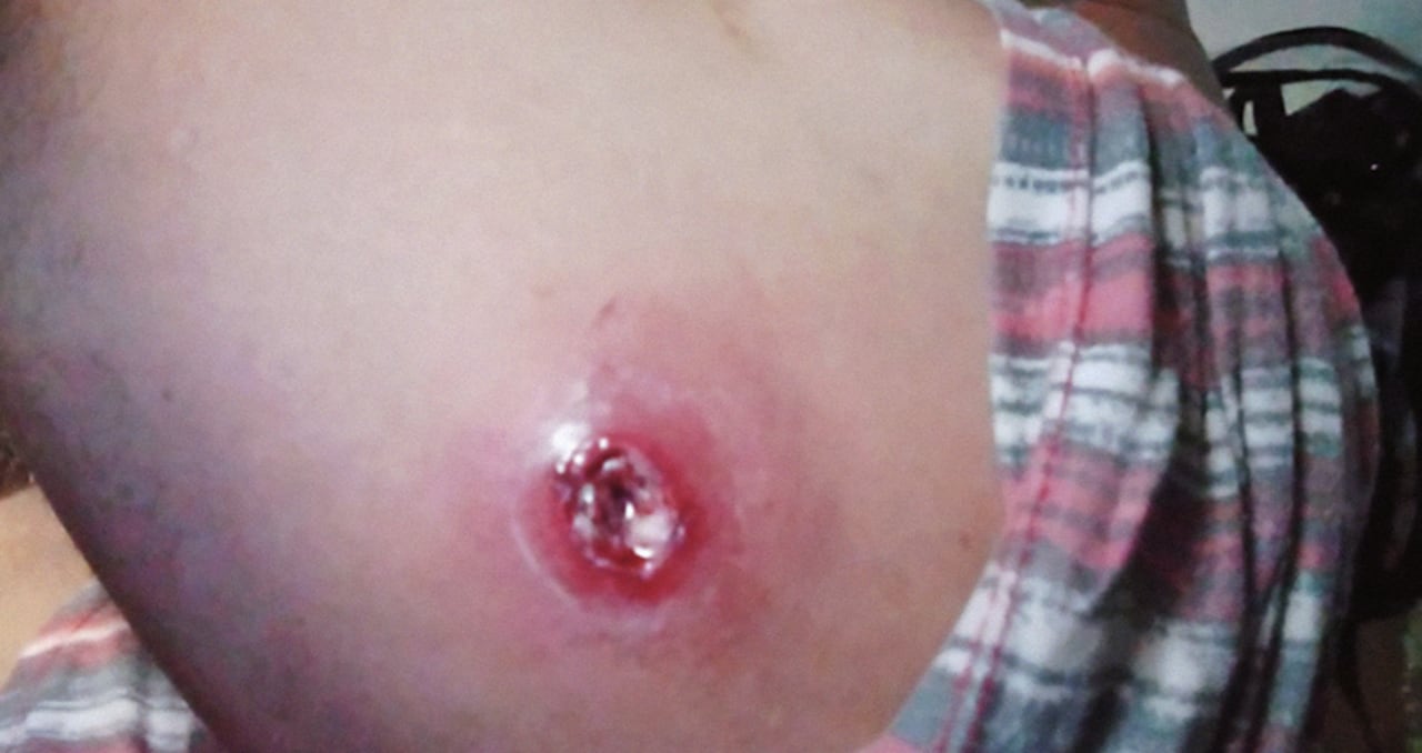 Los privados de la libertad enfrentan graves infecciones por el consumo de agua. Así se ve la piel de uno de los internos infectado.