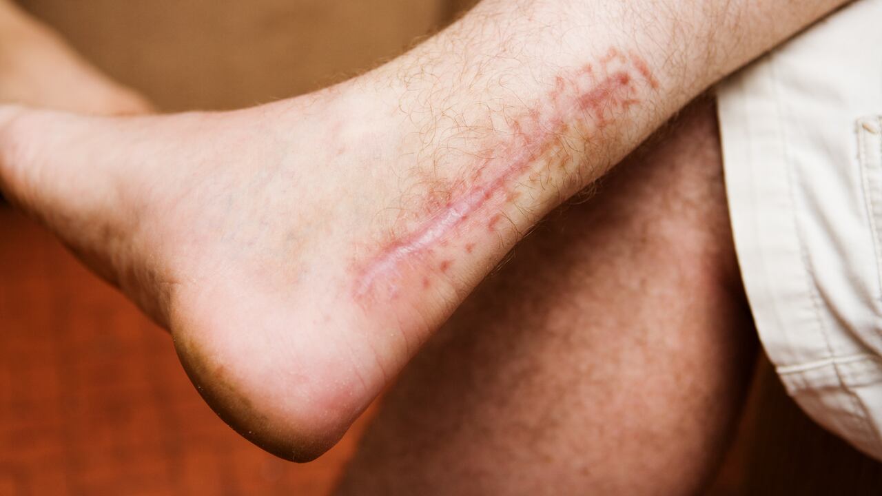 Las cicatrices son marcas de la piel.