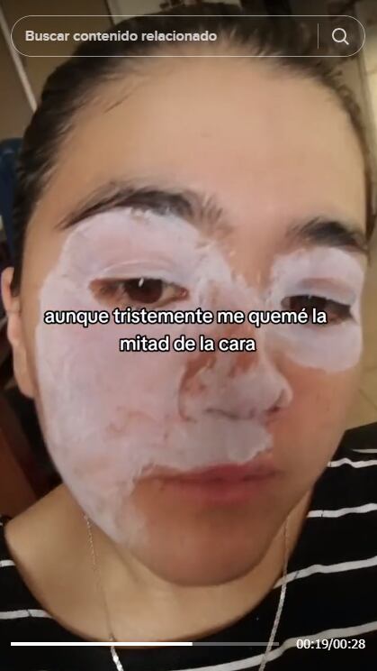 Video: joven sufre quemaduras en la cara tras explosión de olla a presión mientras preparaba lentejas