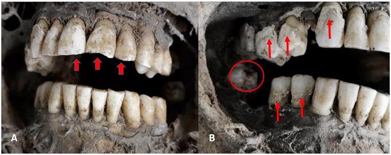 Investigadores revelan el primer caso de embalsamamiento interno sin abrir el cuerpo.