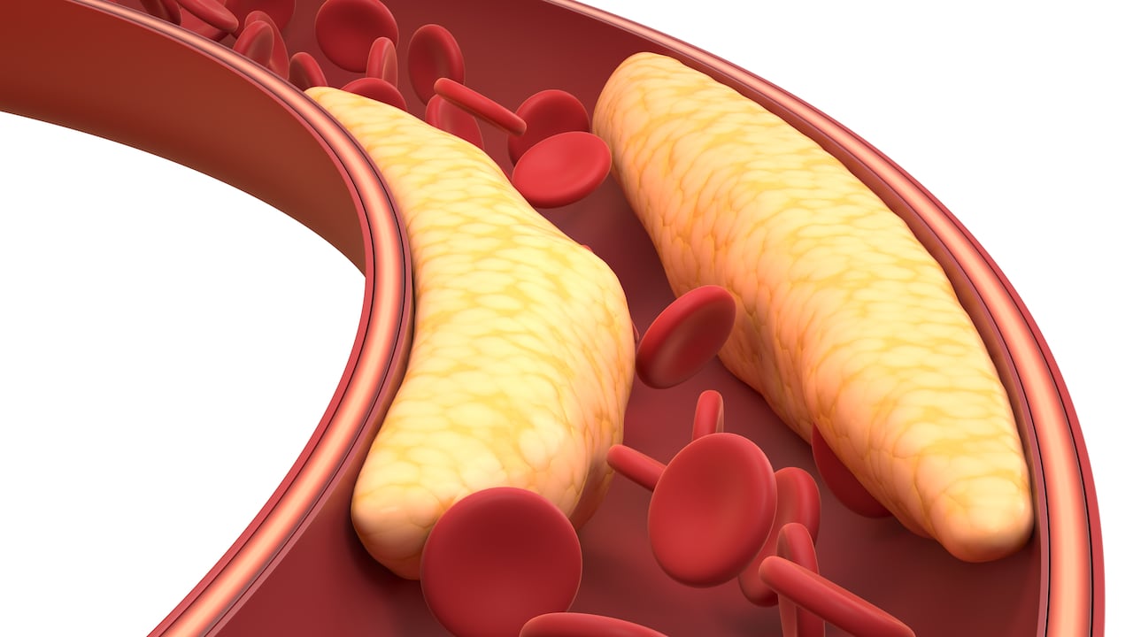 Triglicéridos altos: Estos son los síntomas que indican si los padece