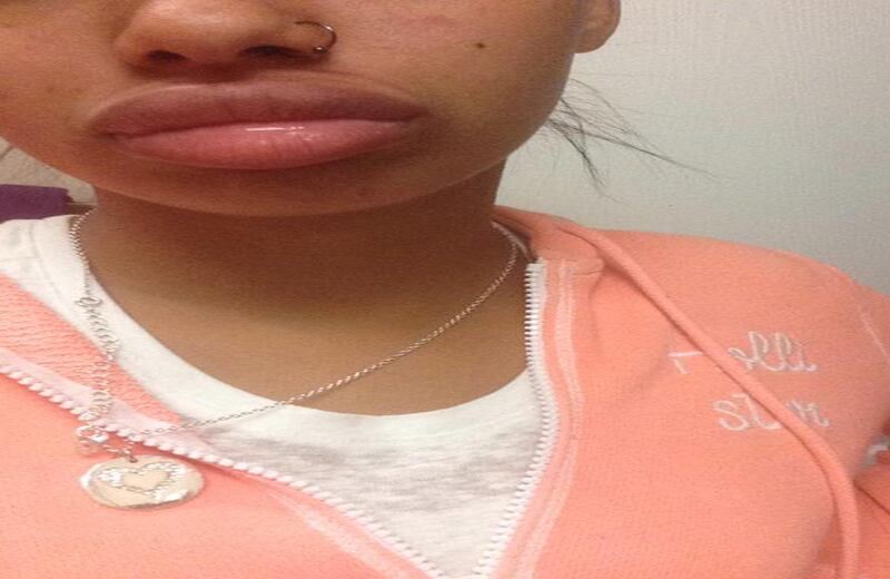 En esta fotografía son visibles las marcas de la copa que introdujo en su boca. 