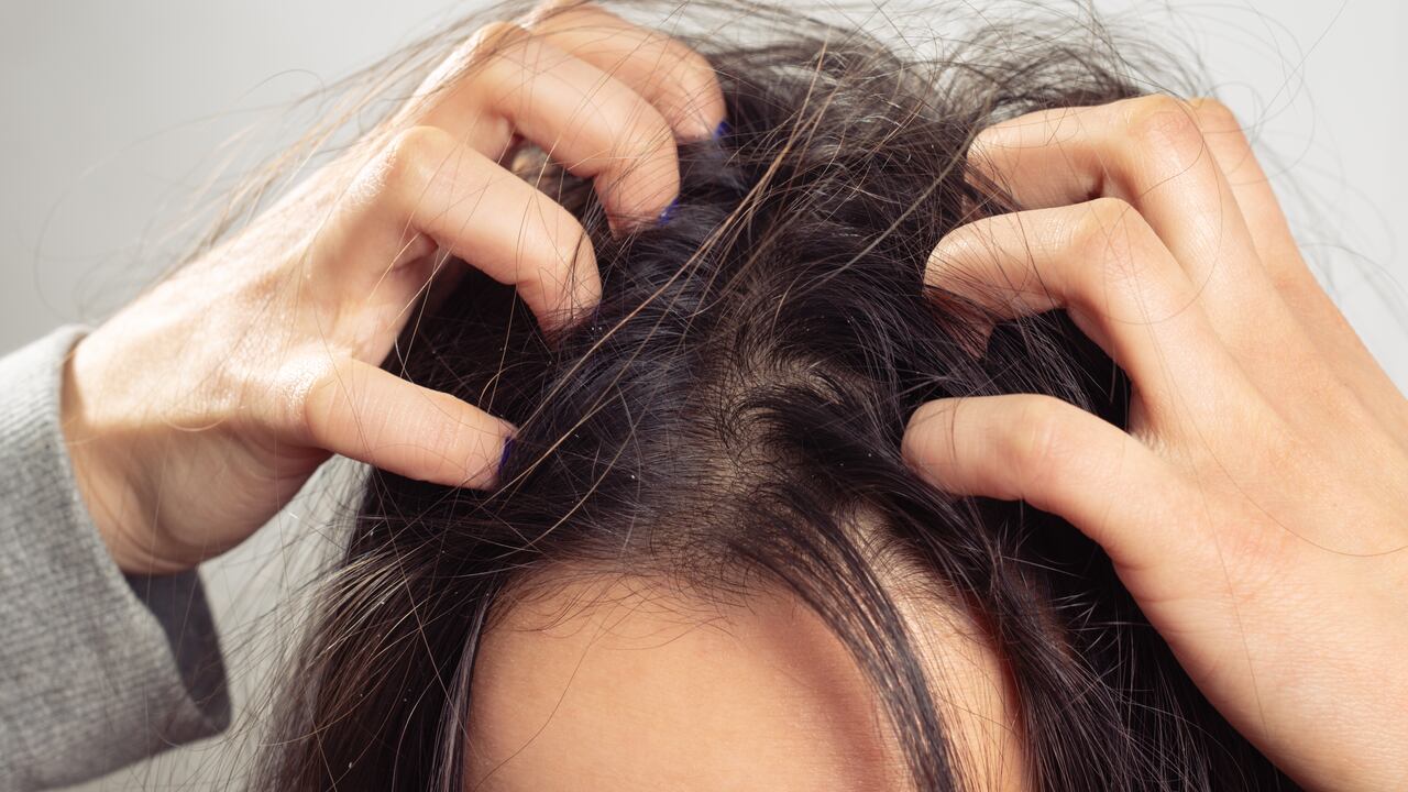 En algunos casos, la caspa puede provocar piquiña e irritación.