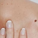 La clave para evitar que los lunares sean peligrosos es proteger la piel de los rayos del sol.