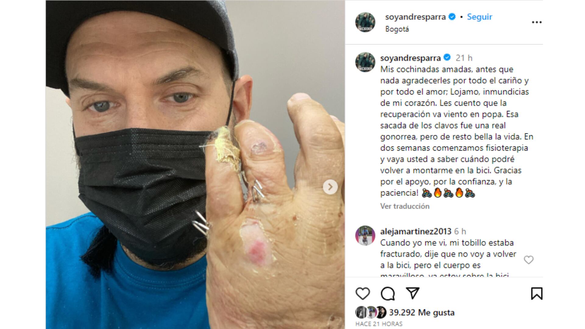 Andrés Parra enseñó el progreso de su recuperación.