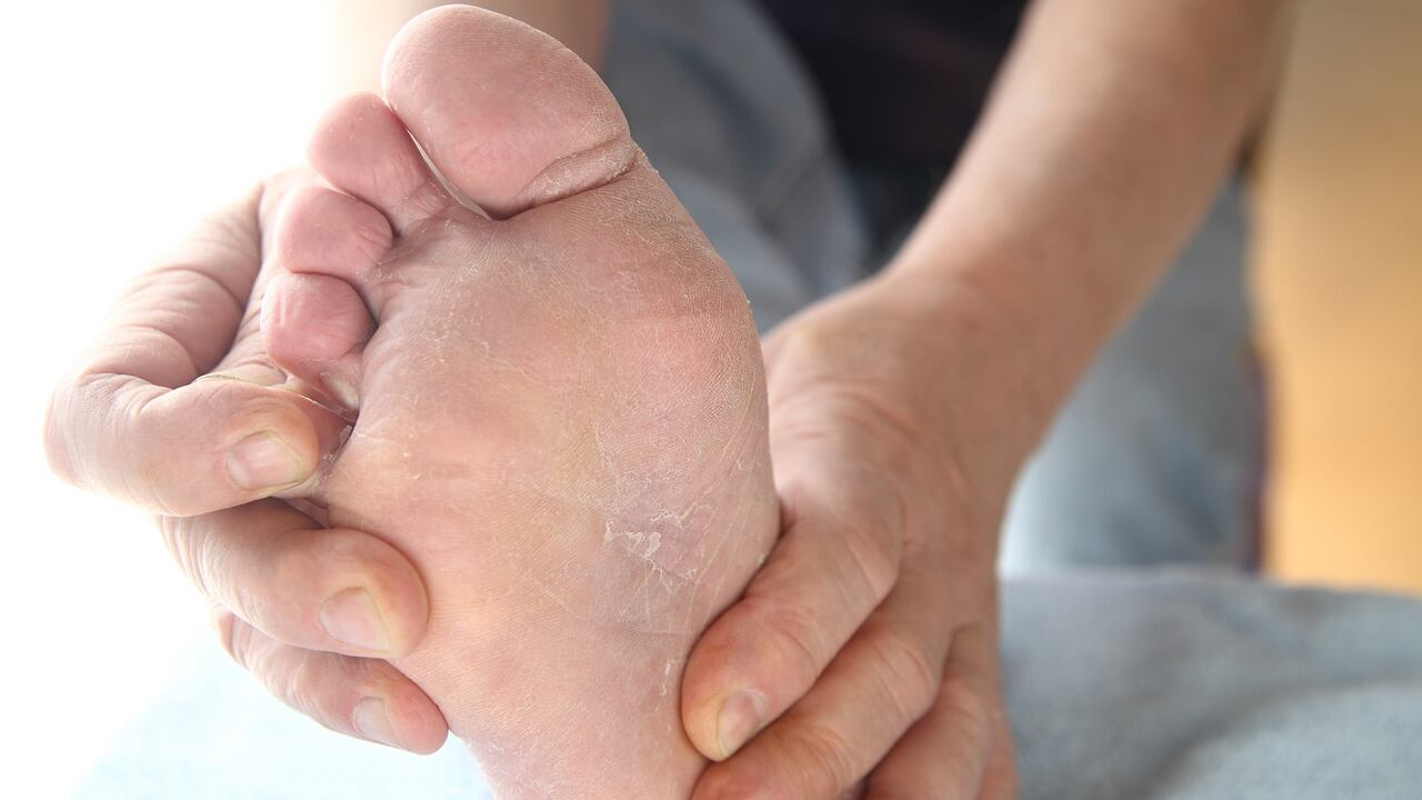 Las lesiones que provoca el pie diabético tienden a ser difíciles de curar.