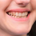 Los dientes amarillos pueden ser resultados de una mala higiene bucal.