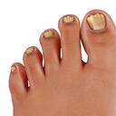 Si luego de dos semanas no se ve mejora de esta infección se recomienda consultar con un médico.