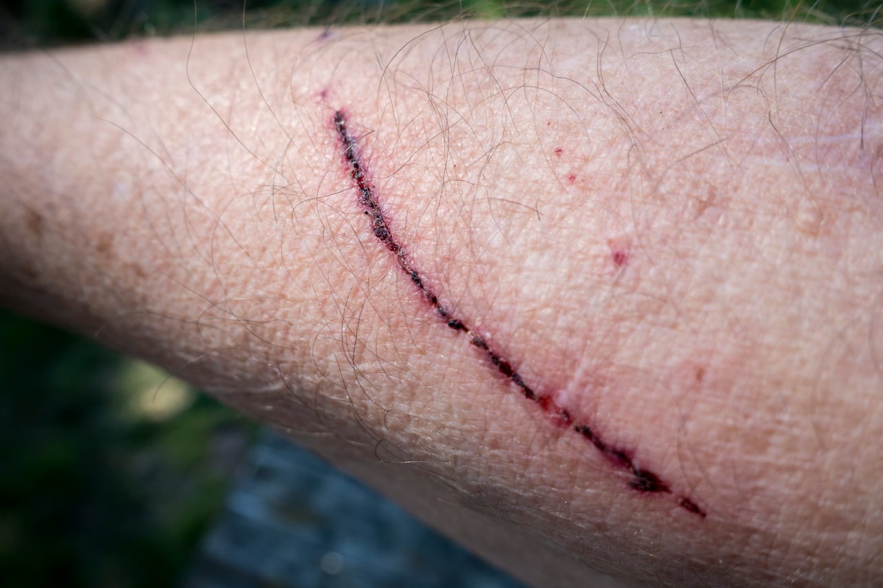 Los rasguños peuden ser profundos o o no.