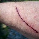 Los rasguños peuden ser profundos o o no.