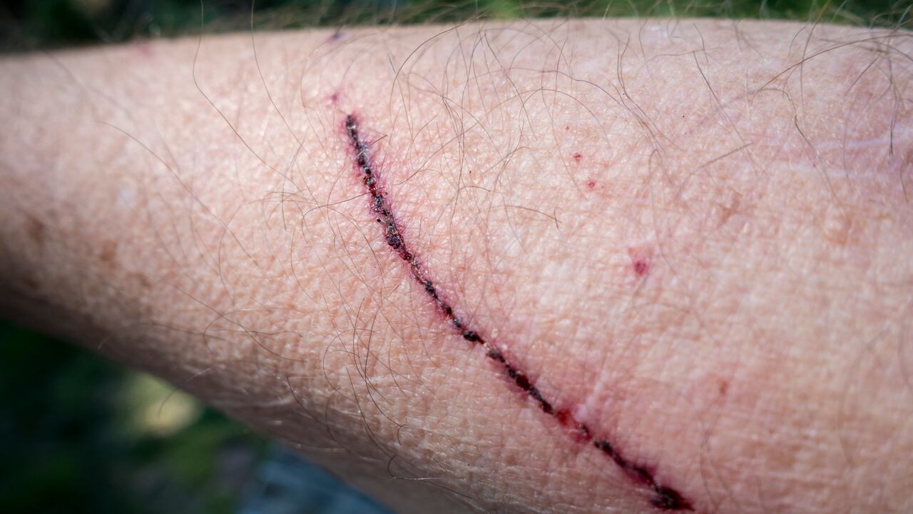 Los rasguños pueden ser profundos o o no.