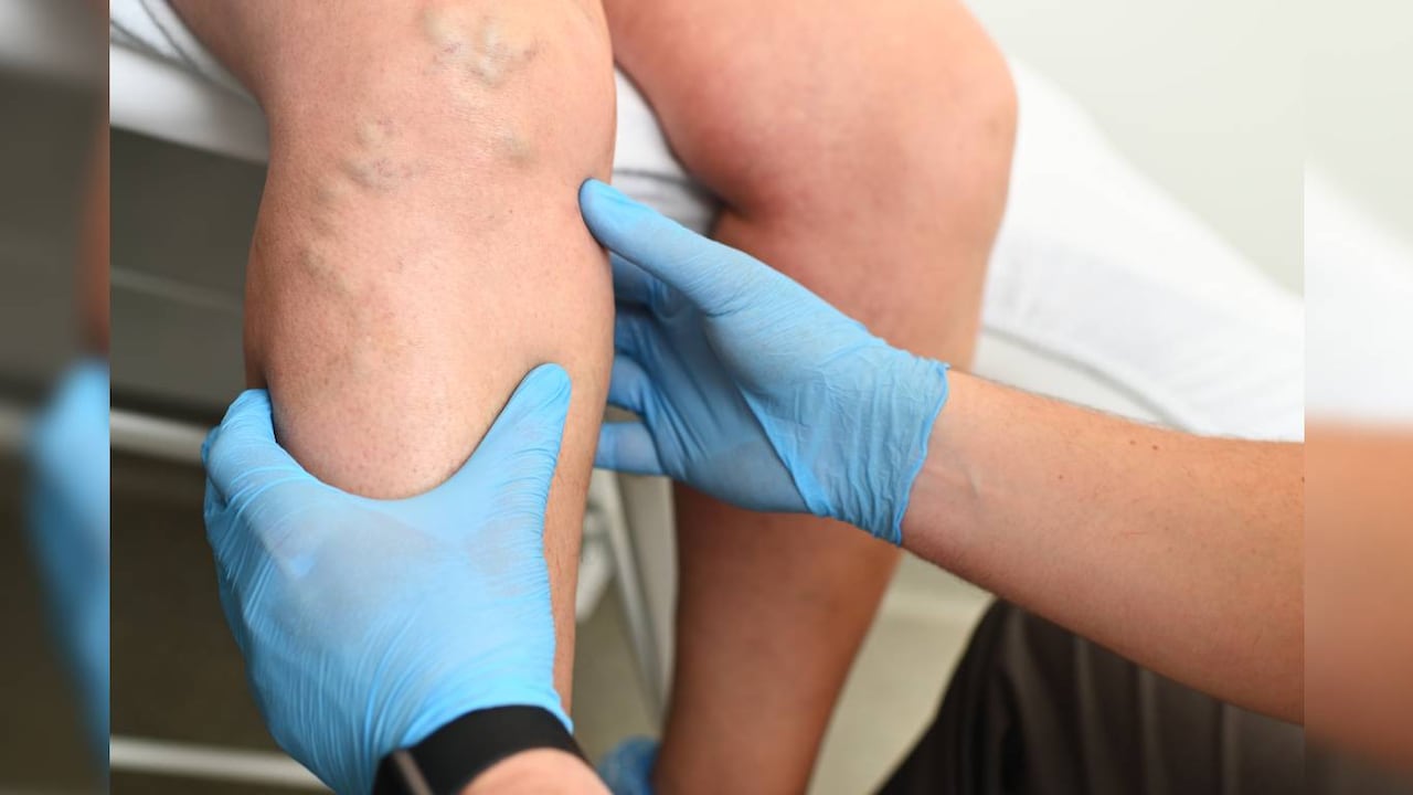 Las venas varicosas pueden generar complicaciones de salud. Foto: Getty Images.