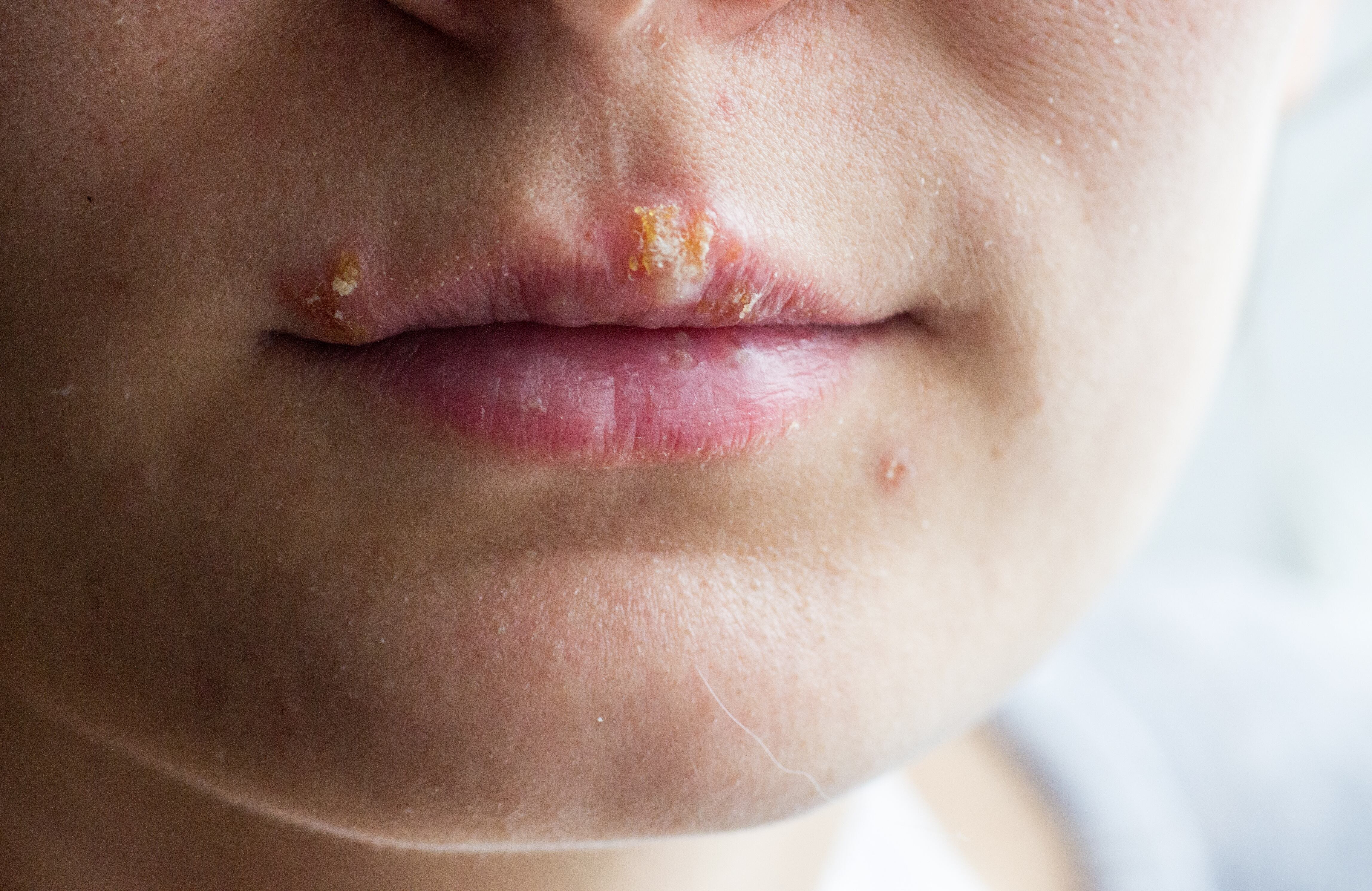 Herpes labial