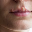 Herpes labial