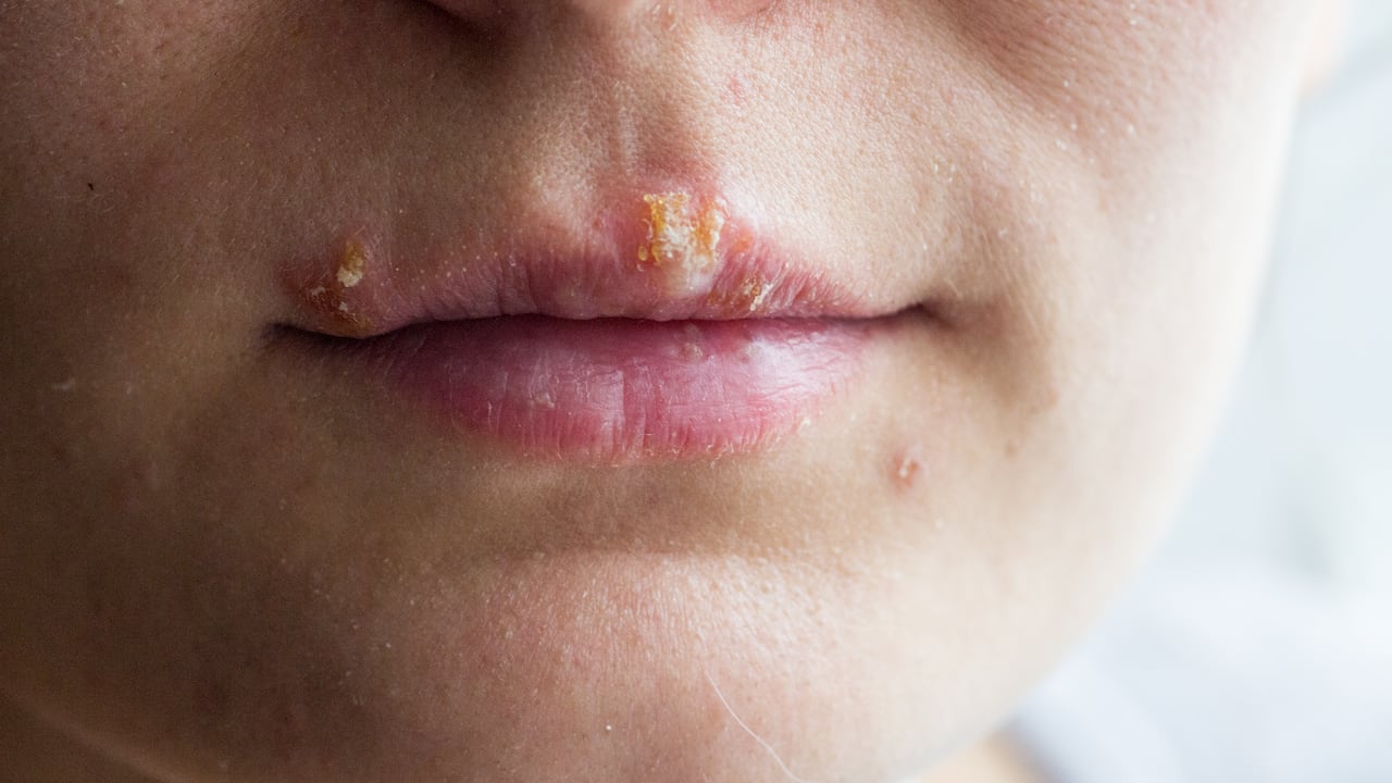 Herpes labial es transmisible