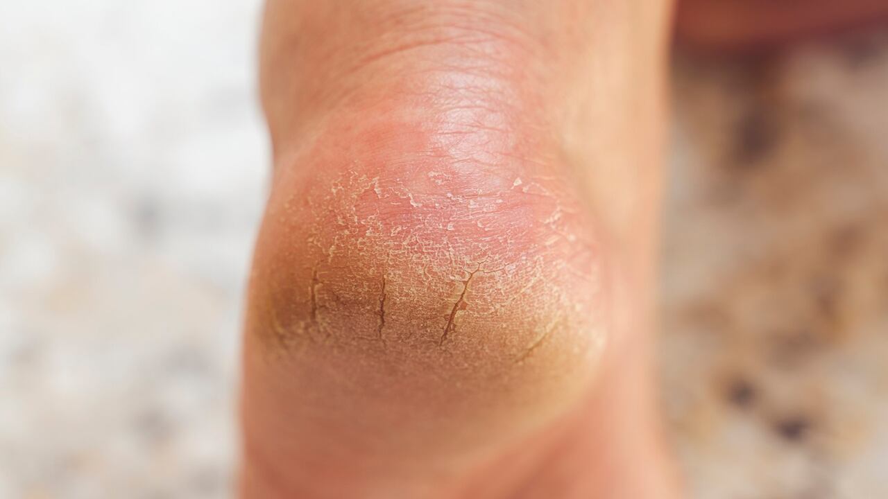 Los talones agrietados pueden ser signo de alguna enfermedad.