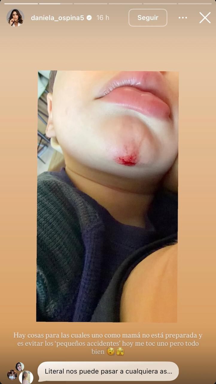Daniela Ospina muestra el golpe que se dio su hijo Lorenzo.