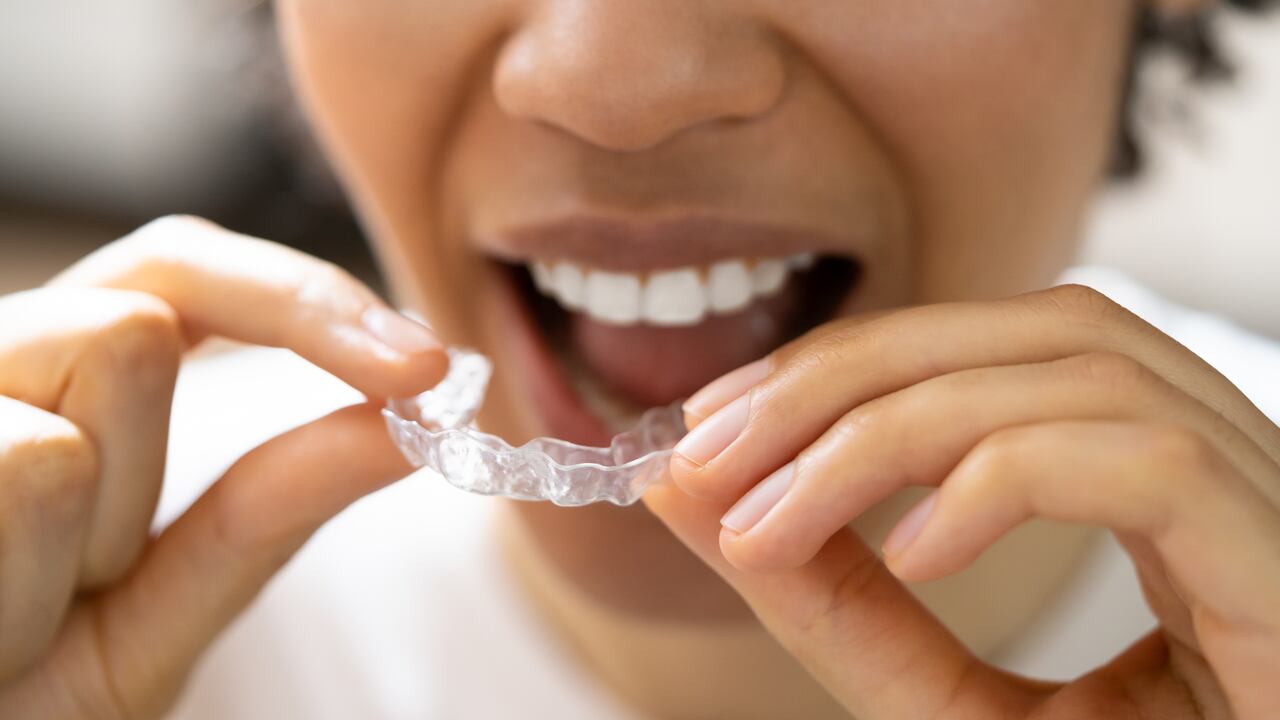 Los alineadores dentales pueden mejorar el bruxismo.