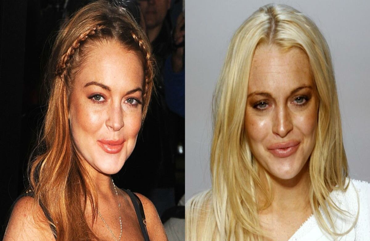 Cirujanos plásticos han dicho a los medios que la actriz Lindsay Lohan se puso implantes en el rostro y los labios.