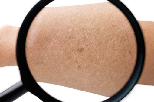 Es una condición que compromete la salud de la piel; el cual causa grandes molestias para quien la sufre.