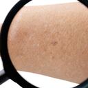 Es una condición que compromete la salud de la piel; el cual causa grandes molestias para quien la sufre.