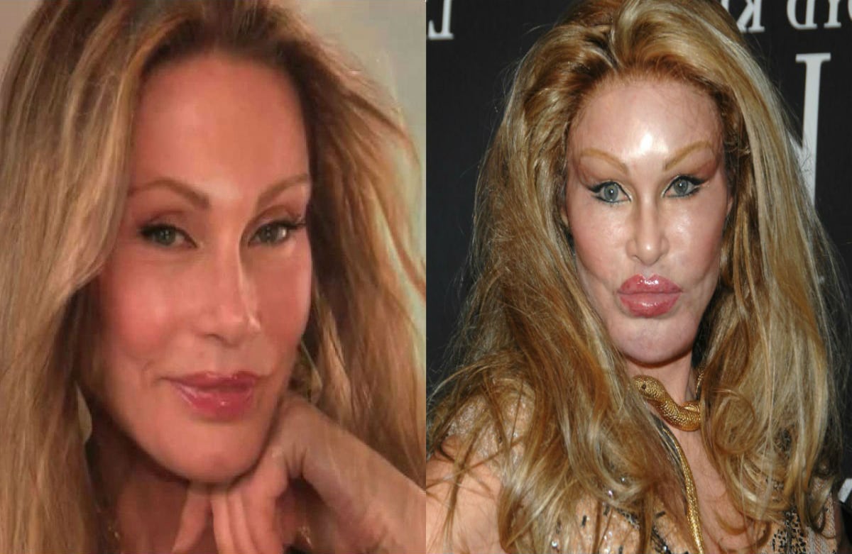 La ‘socialite’ neoyorquina Jocelyn Wildenstein tiene implantes en las mejillas y múltiples estiramientos faciales. Es conocida como ‘cat woman’ por su aspecto felino.
