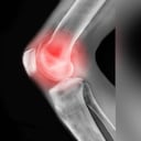 La artrosis es una enfermedad degenerativa de los huesos que inicia con la destrucción o perdida gradual del cartílago articular. Foto: Getty Images.