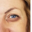 bolsas en los ojos y ojeras