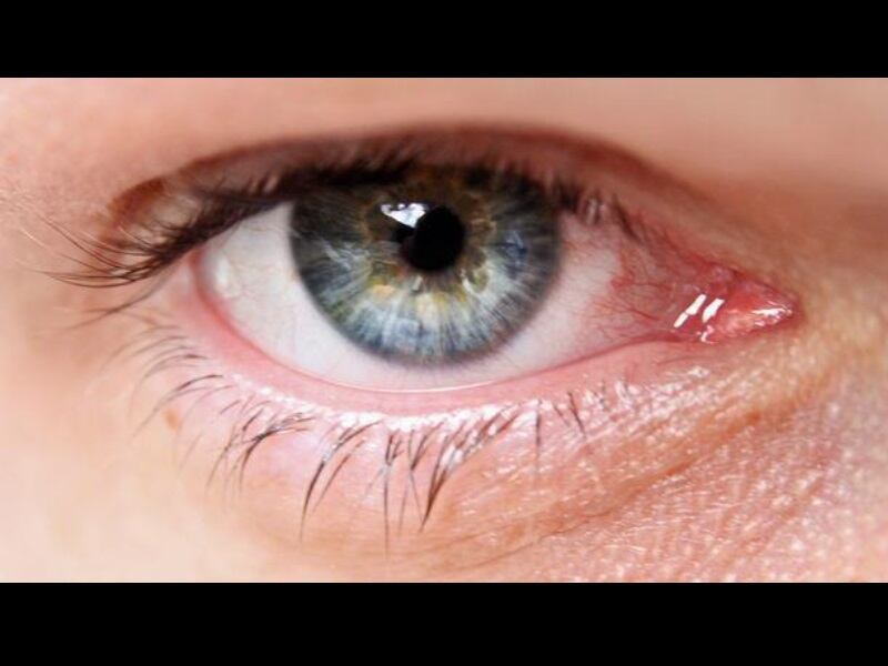 El glaucoma es una de las principales causas de ceguera en el mundo. 