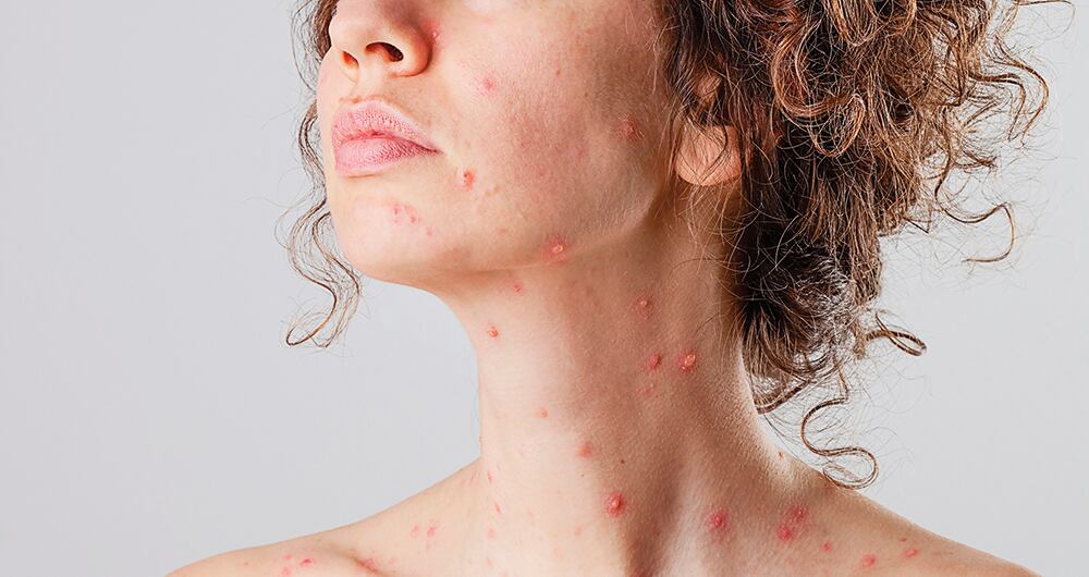 La viruela de mono ha matado a 500 personas en los últimos 100 años.