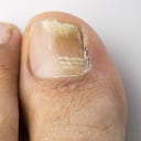 Los hongos en las uñas producen una decoloración blanca, café o amarilla; también puede hacer que se engrosen o quiebren. Foto: GettyImages.