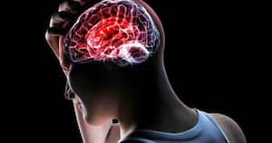 La parálisis Cerebral incluye un grupo de condiciones permanentes y no progresivas que comprometen la movilidad.