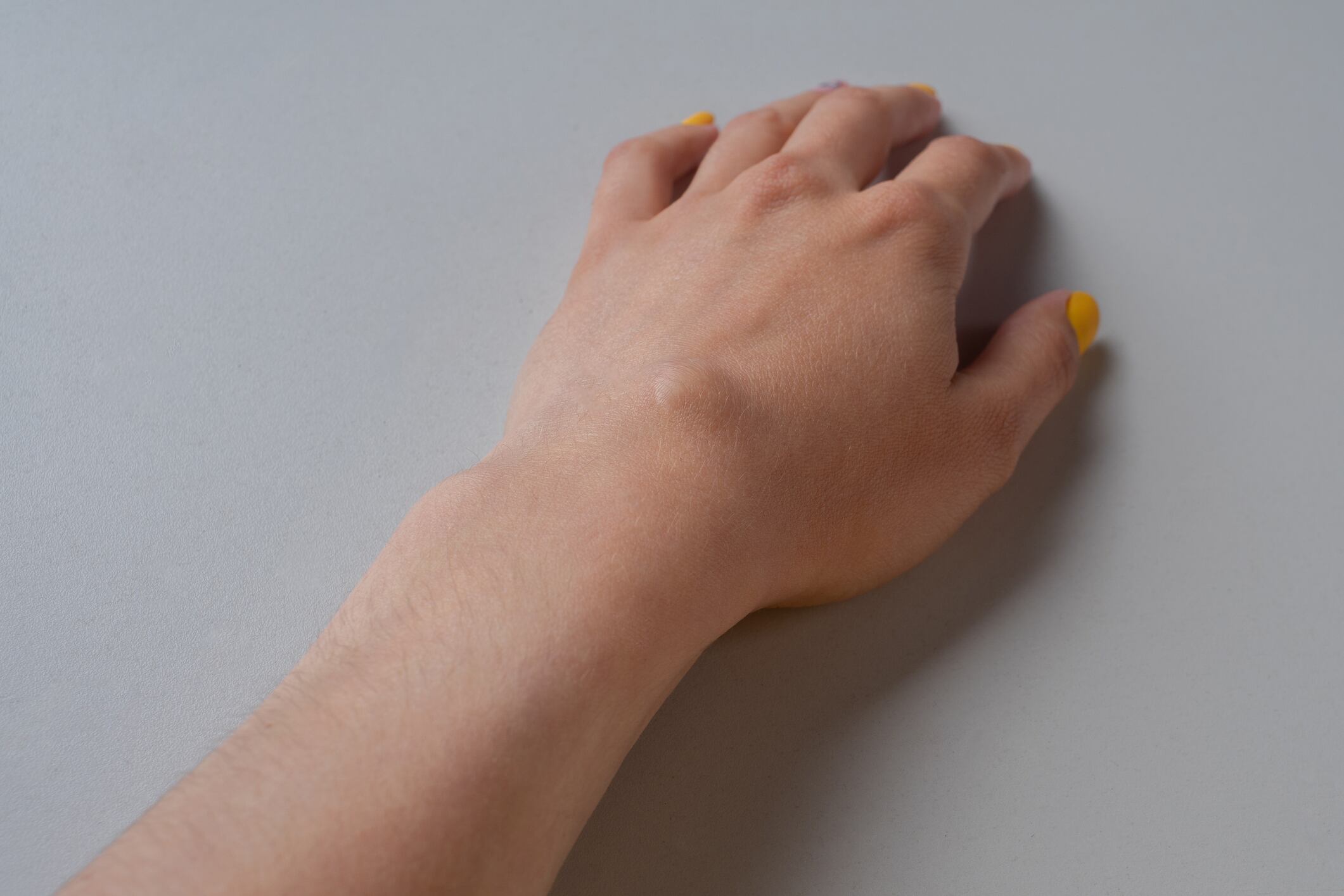 Los bultos que se presentan en las manos no siempre son un indicio de cáncer.