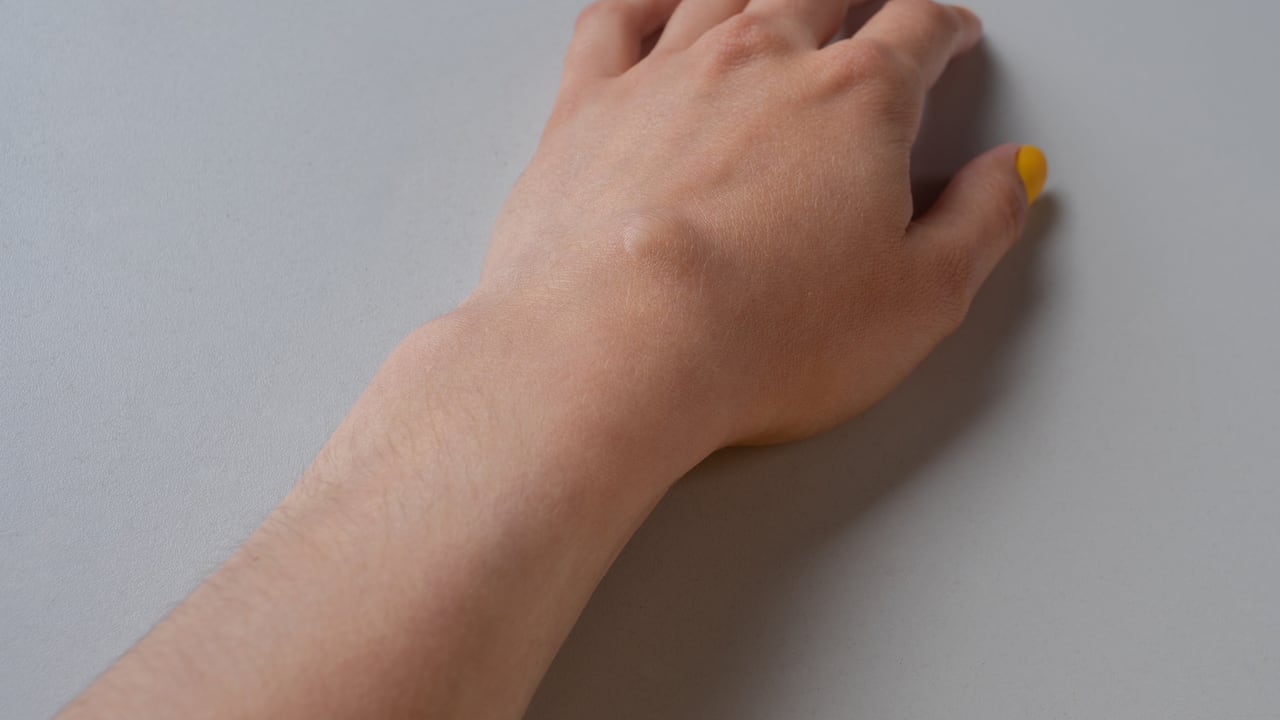 Las protuberancias en las manos no siempre son indicio de una enfermedad grave.