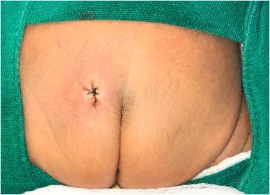 Bebé luego de la cirugía