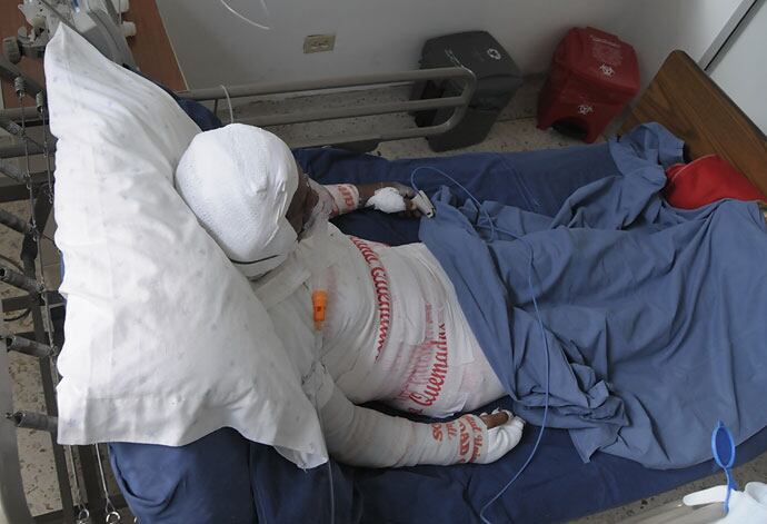 El Hospital Universitario del Valle informó que hasta el 19 de diciembre, último día en el que recibieron quemados con pólvora en el HUV, registraban 14 lesionados. De ellos, cinco son menores.
