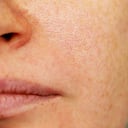 Los desordenes hormonales pueden aumentar la aparición de poros abiertos en la piel del rostro.