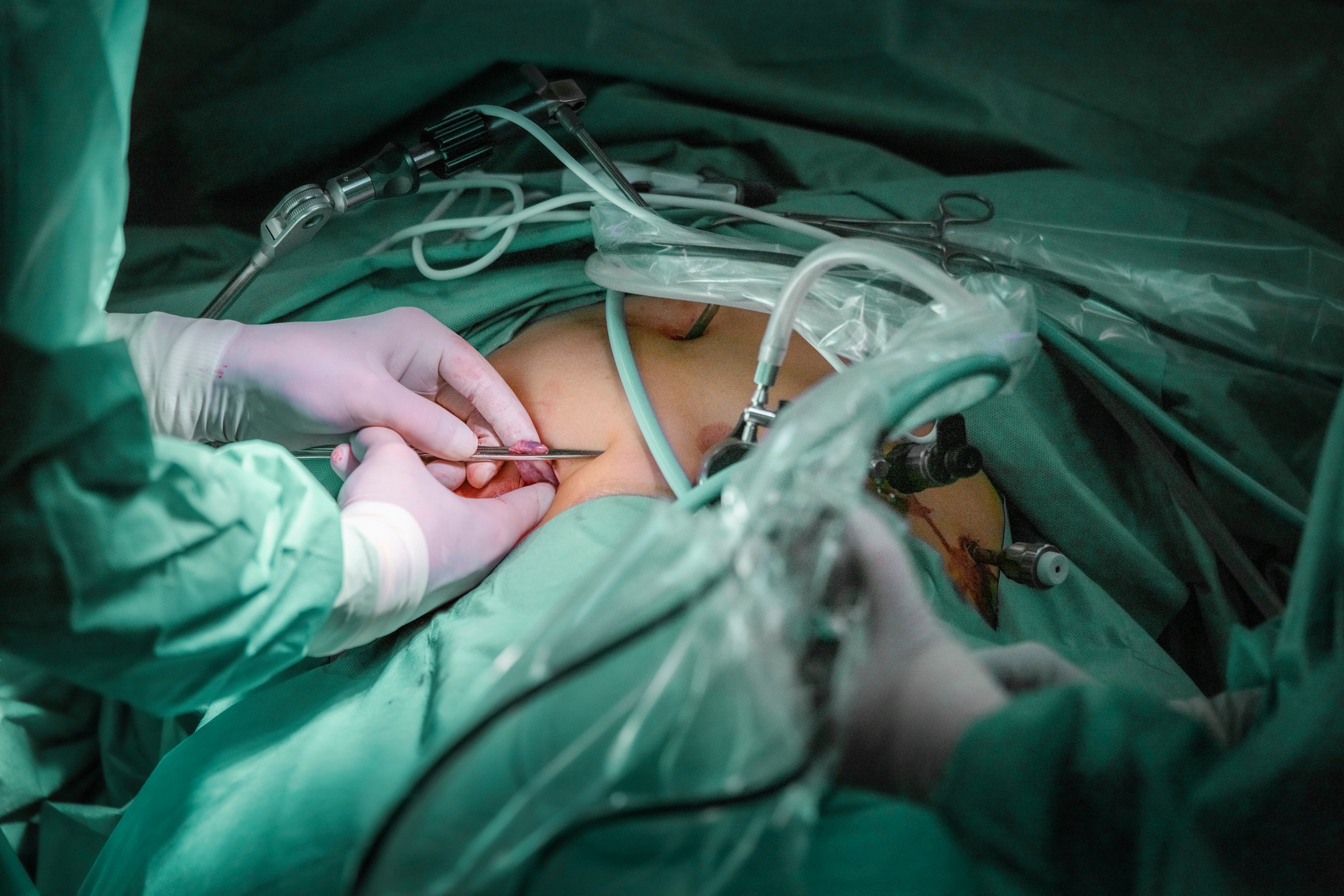 Los médicos realizan una cirugía de bypass gástrico en el quirófano.