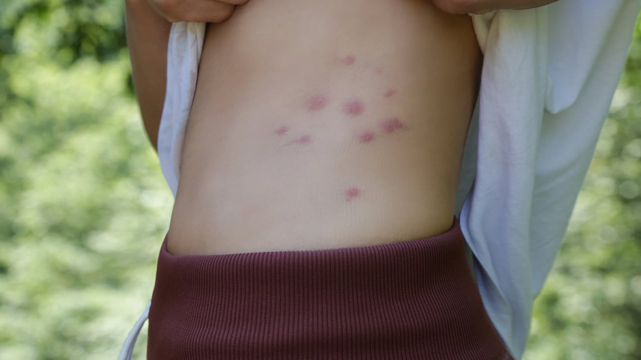 Picadura de insectos