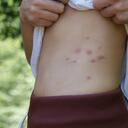 Las pulgas pueden generan afecciones de salud con sus picaduras.