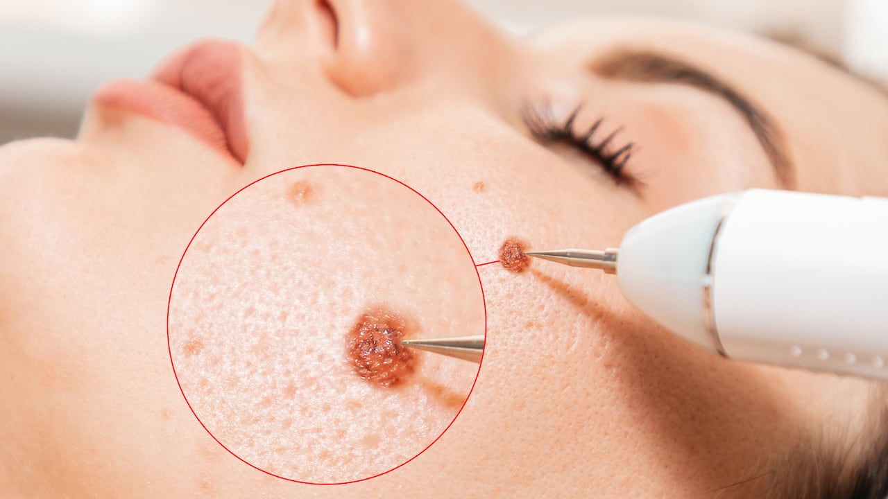 Aunque se tiene el imaginario de que el papiloma se relaciona con un virus genital, no siempre se trata de la misma afección. Foto: Getty Images