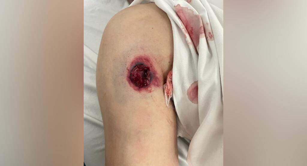 Estas eran las heridas que le ocasionaban con armas traumáticas y destornilladores una banda de paseo millonario a sus víctimas, ciudadanos extranjeros en Medellín, según la Policía.