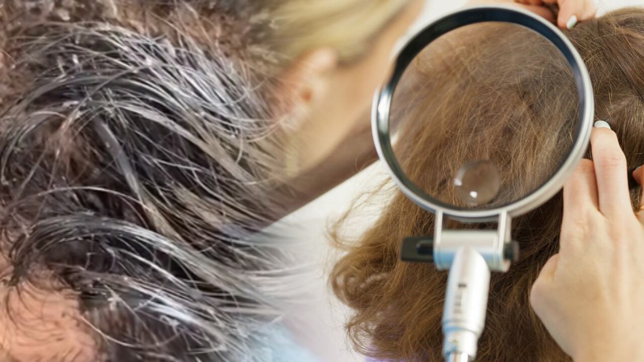 Los piojos son pequeños insectos que se alojan con frecuencia en la cabeza,