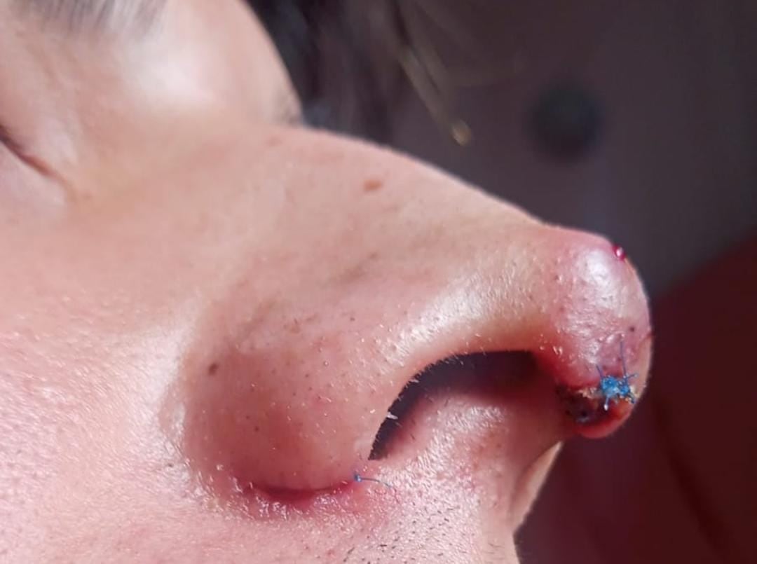 Afectación tras rinoplastia